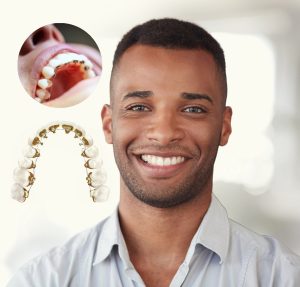 How Braces Help Fix Complex Alignment Issues